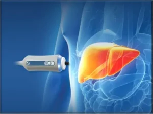 Understanding Liver Elastography A Non-Invasive Approach to Liver Health
