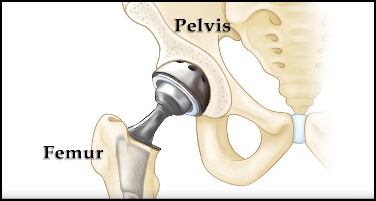 Understanding Total Hip Replacement When and Why It's Considered