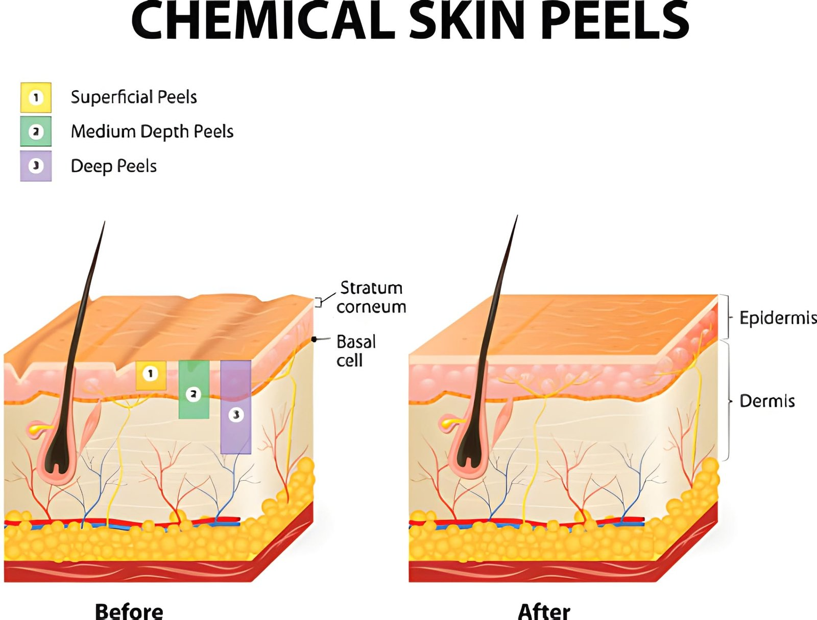 Chemical Peel Strength Levels: Light, Medium, And Deep — What Really Changes For Your Skin?