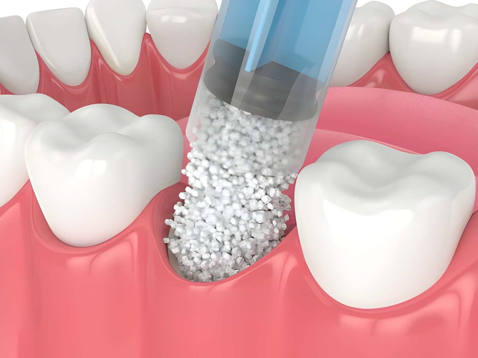 The Role Of Bone Grafting In Implant Dentistry